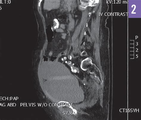 rectus sheath mass icd 10.